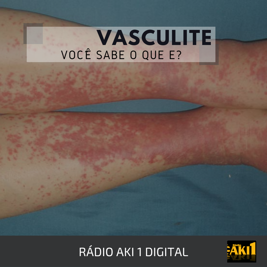 O que são as Vasculites Rádio Aki1 Saúde