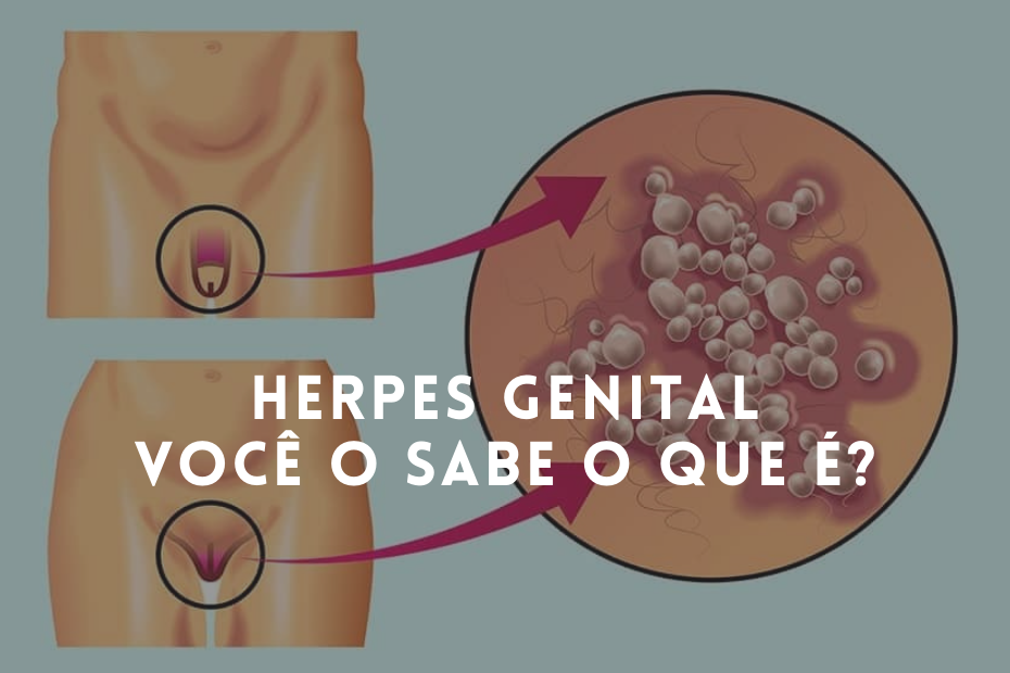 Herpes Genital