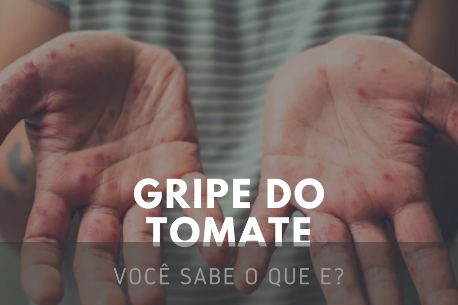 Gripe do Tomate