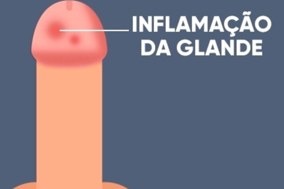 Balanite: causas, sintomas, tratamento e prevenção da inflamação da glande do pênis