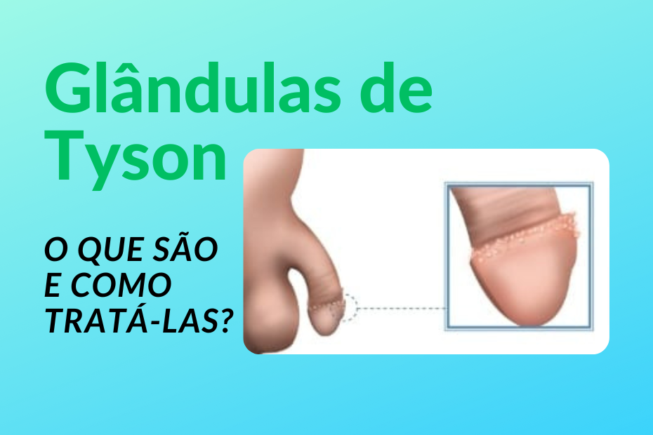 Glândulas de Tyson: O que são e como tratá-las?
