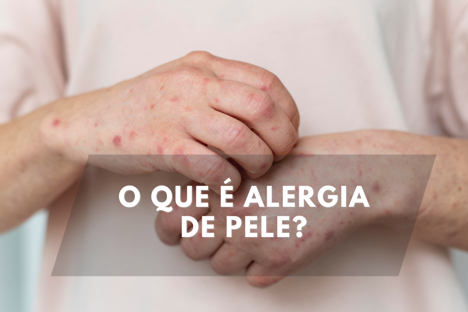 O que é alergia de pele?