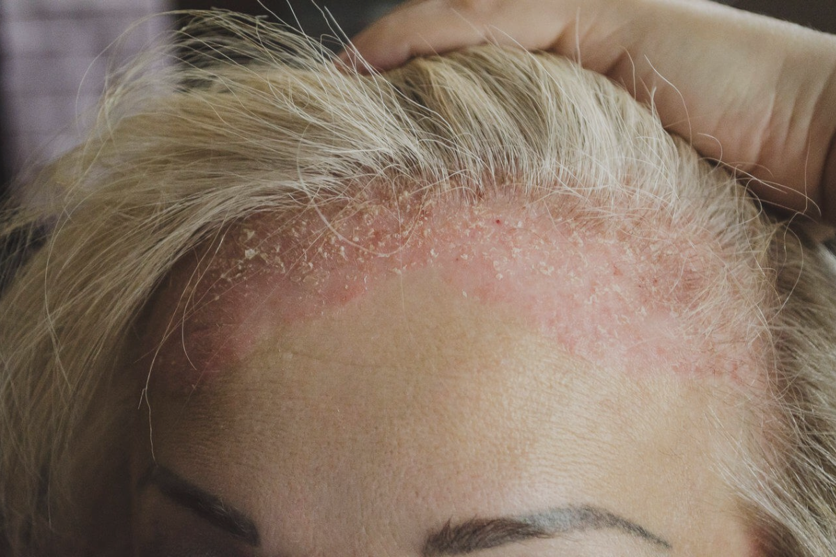 O que é a dermatite seborreica?