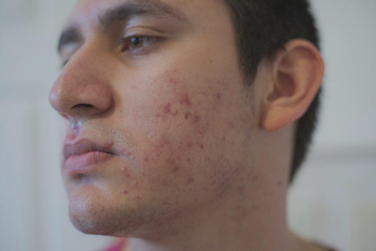 Como prevenir e tratar a acne em homens adultos?
