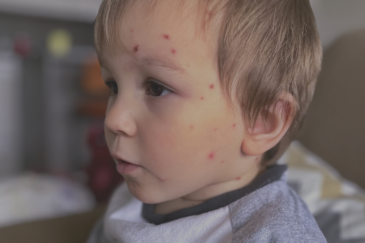 Sinais de Alergia na Alimentação do Bebê