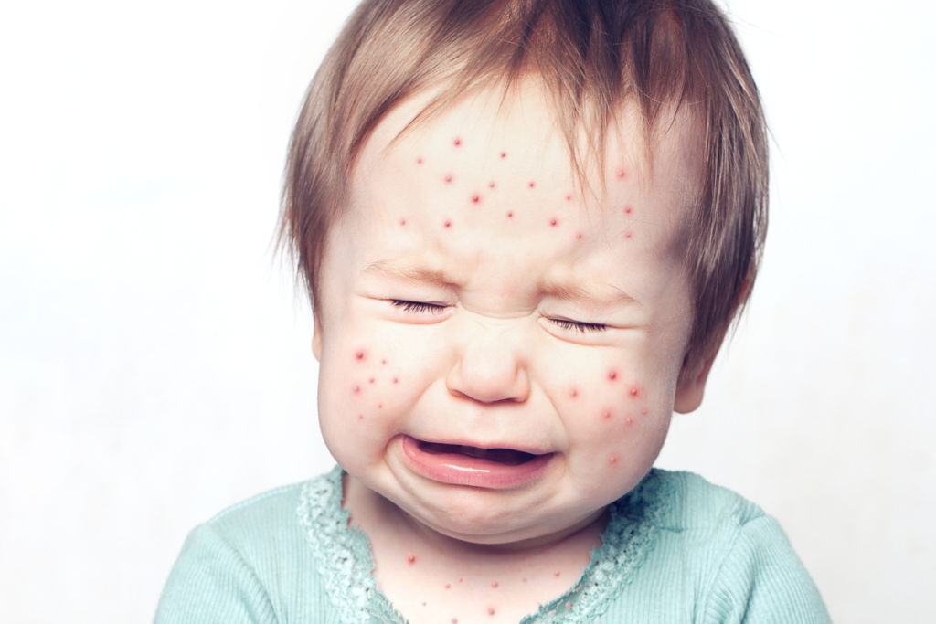 Sinais de Alergia na Alimentação do Bebê