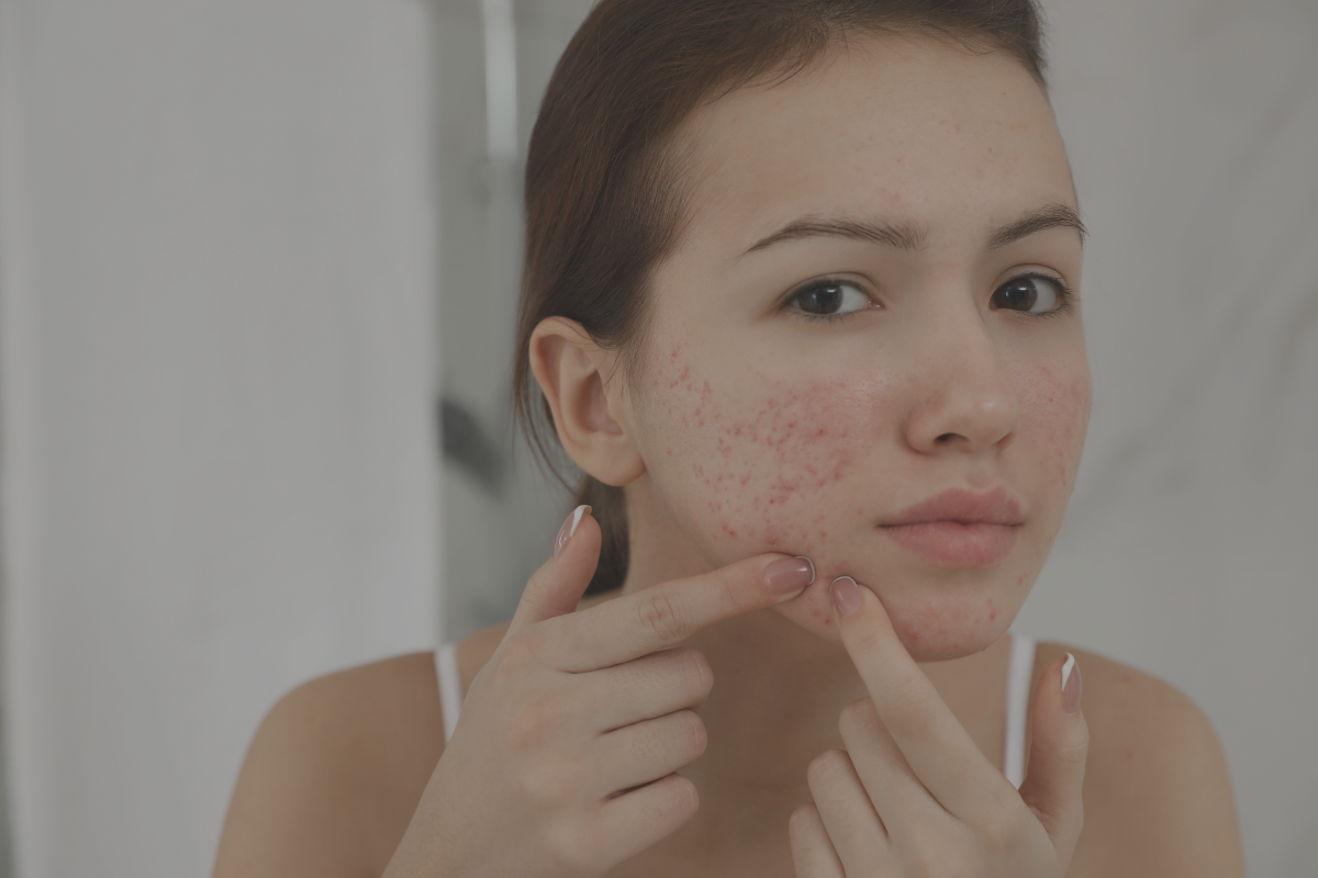 Acne Causas, Sintomas e Tratamentos Eficazes