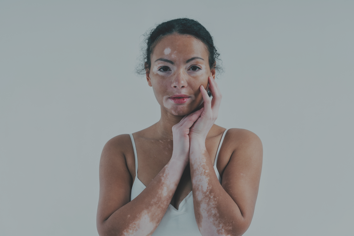 Vitiligo: Sintomas e Tratamentos